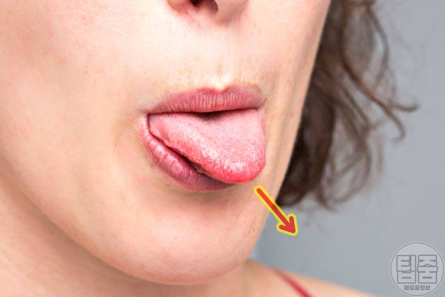 치매 안걸리는 방법 뇌위축 치매예방 혀운동 효과