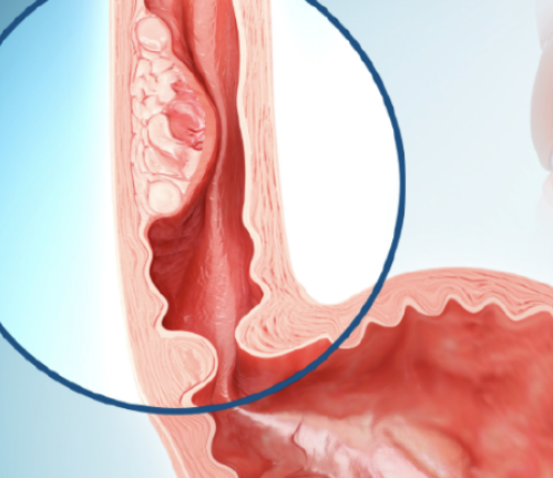 식도암 초기증상 2