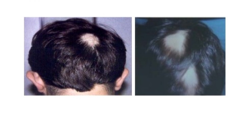 원형탈모 이미지