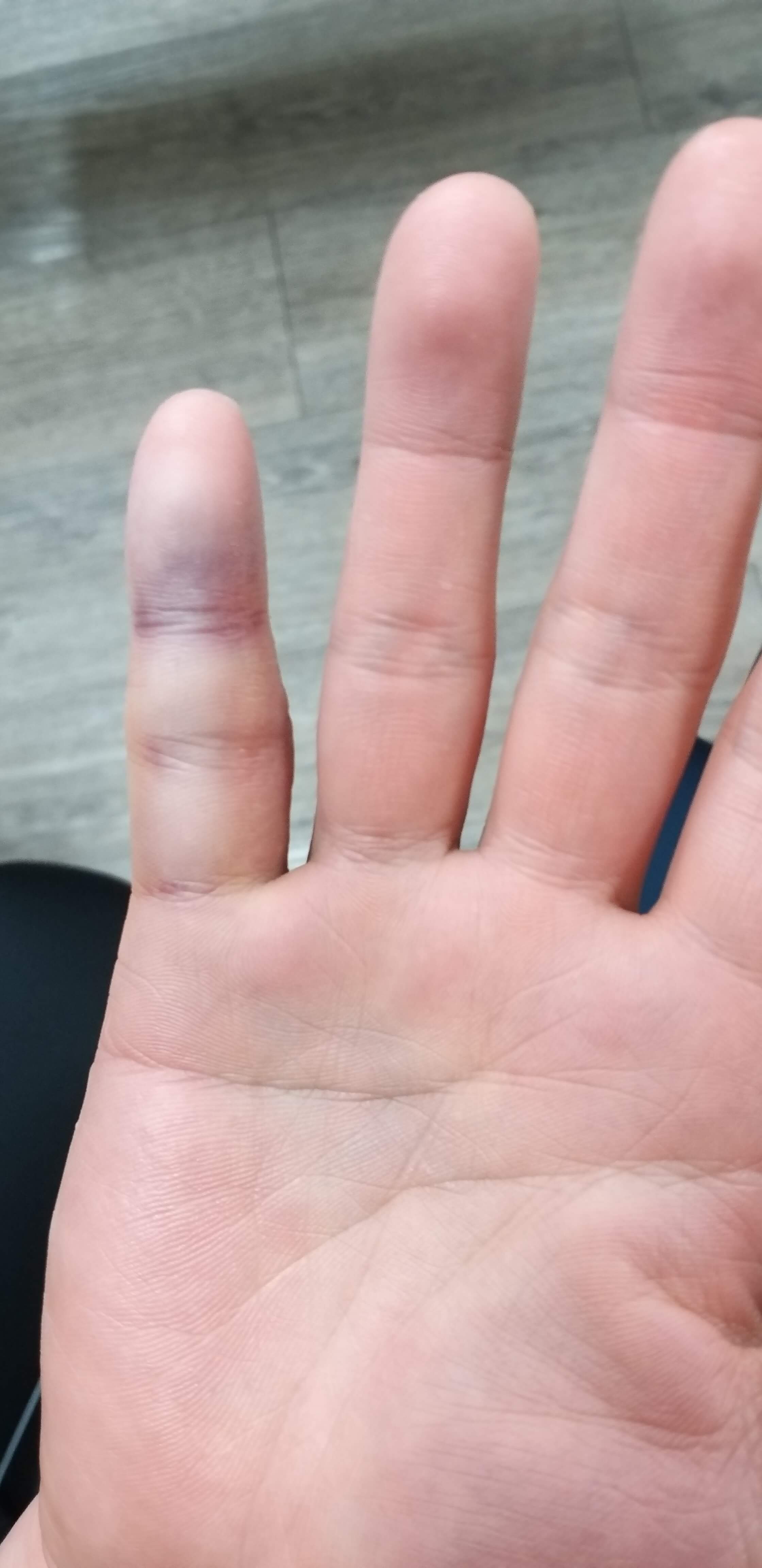 퉁퉁부은손가락사진1