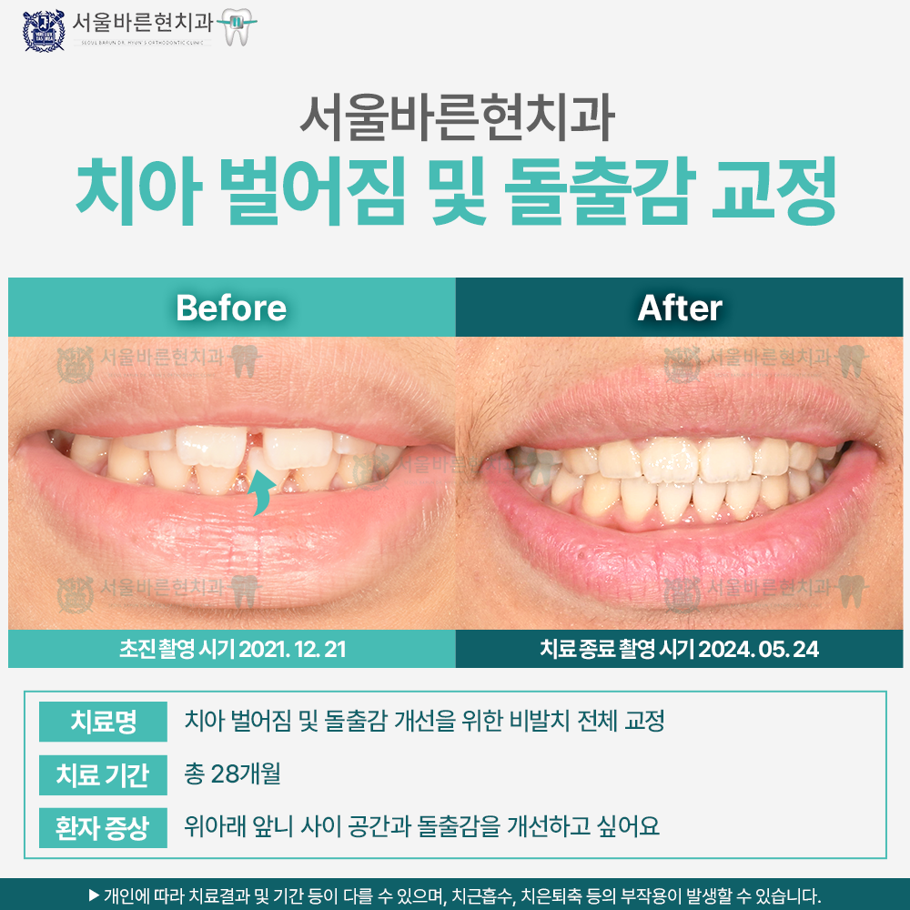 해운대돌출입교정