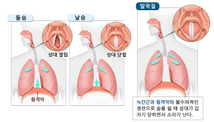딸국질의 원인과 건강신호