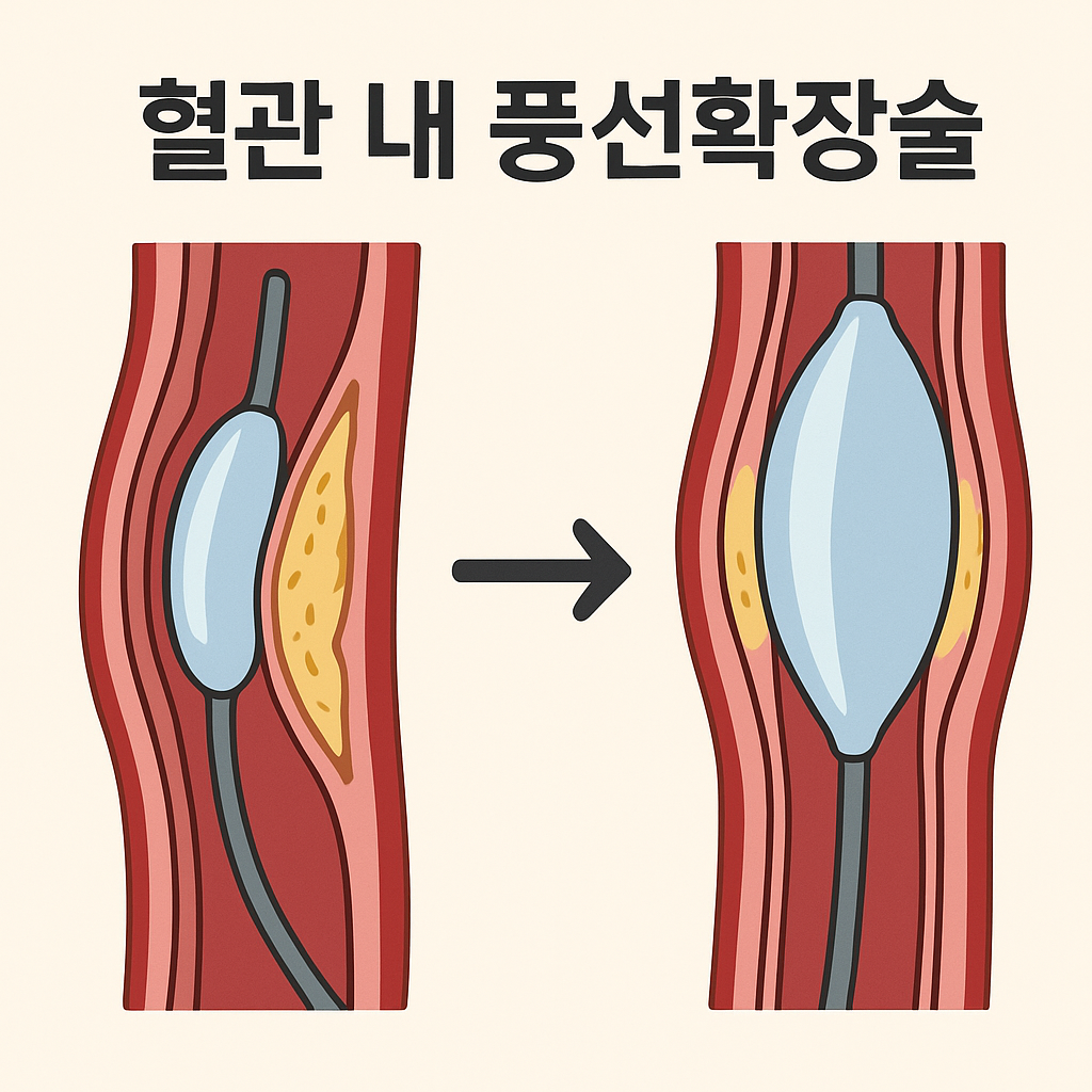 혈관외과 시술, 혈관 내 풍선확장술 (PTA)