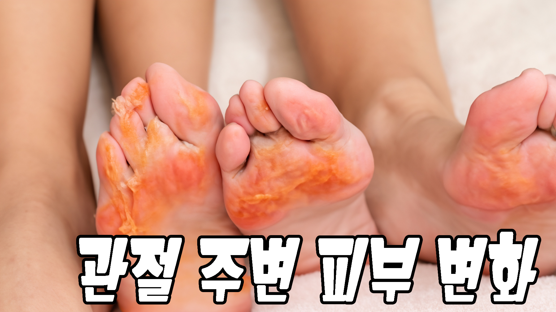 관절 주변 피부 변화