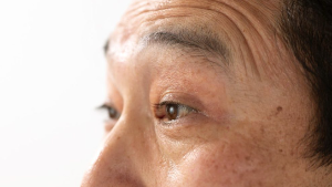 안검하수 증상 원인