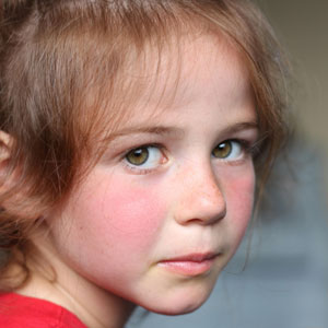 감염성 홍반 증상 - 볼이 빨개짐