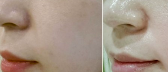 아쿠아필 효과와 시술대상 주기 가격