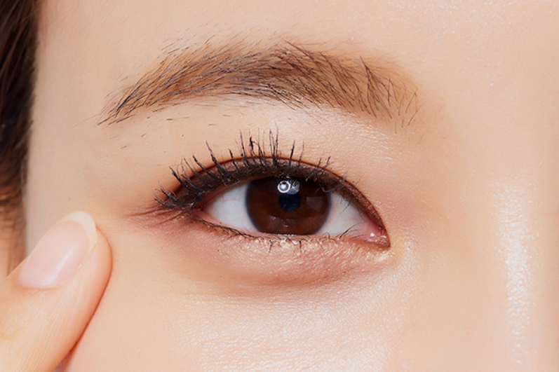 트임성형 앞트임이 필요한 경우는?