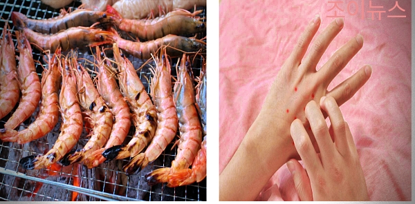 새우(갑각류) 식품알레르기 증상