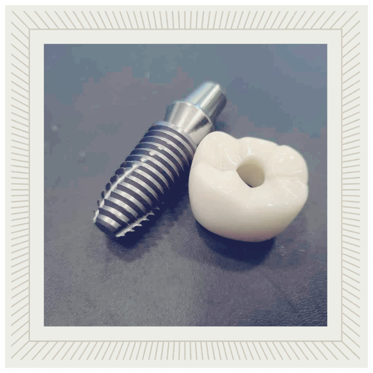 치과 임플란트 건강보험적용가격