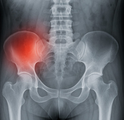 골반 통증 원인