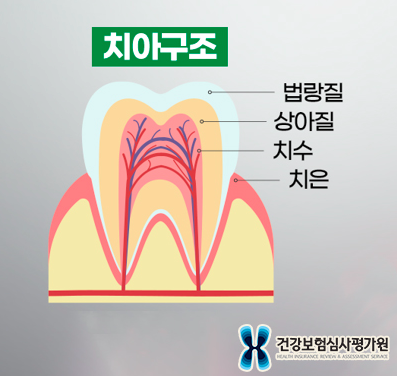 치수염-원인