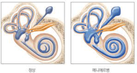 메니에르병
