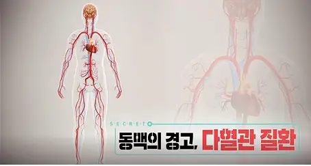 KBS 생로병사의 비밀 831회 뇌혈관, 심혈관, 말초혈관 두 곳 이상 동맥 경화 다혈관질환 주의할 점 오늘방송 다시보기 정보