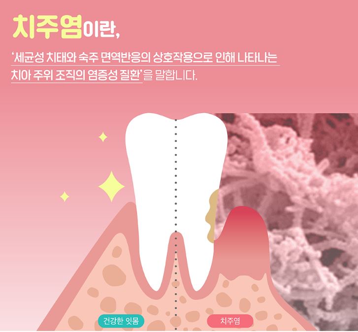 치주염
