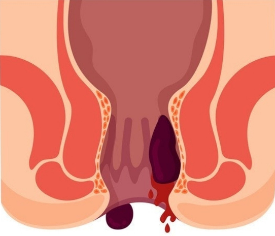 항문 속에서 발생한 내치질과 항문 주변에 발생한 외치질을 그린 그림 사진