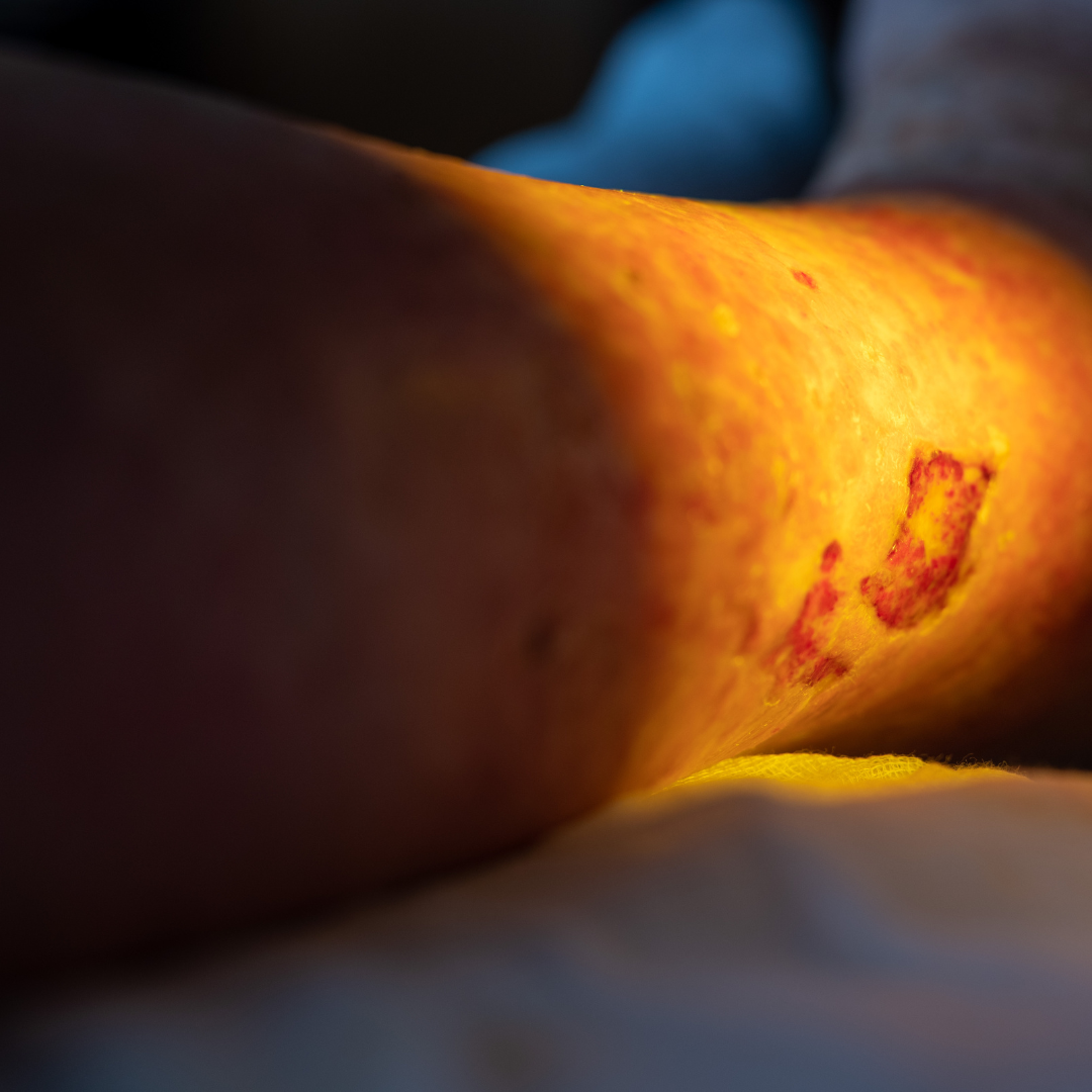 욕창 예방 치료 증상 원인