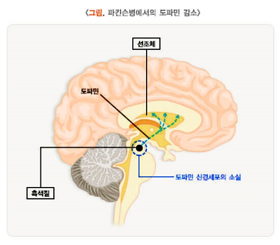 파킨스-이미지