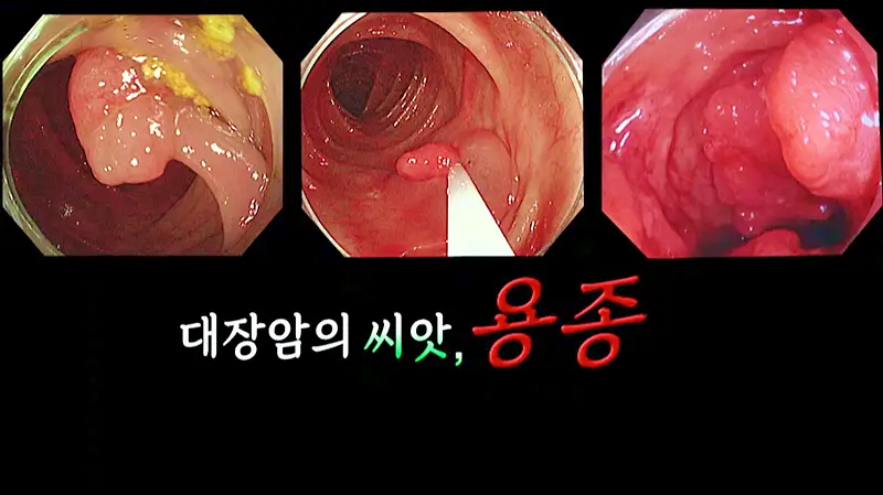 명의 용종에서 암까지, 대장의 비밀 건강검진 대장 내시경 검사 치료 방법 가천대 길병원 대장항문클리닉 백정흠, 소화기내과 권광안 전문의 교수 예약 추천