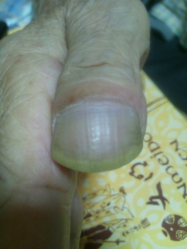 손가락이 ‘이 모양’ 이라면… 당장 병원부터 가세요.