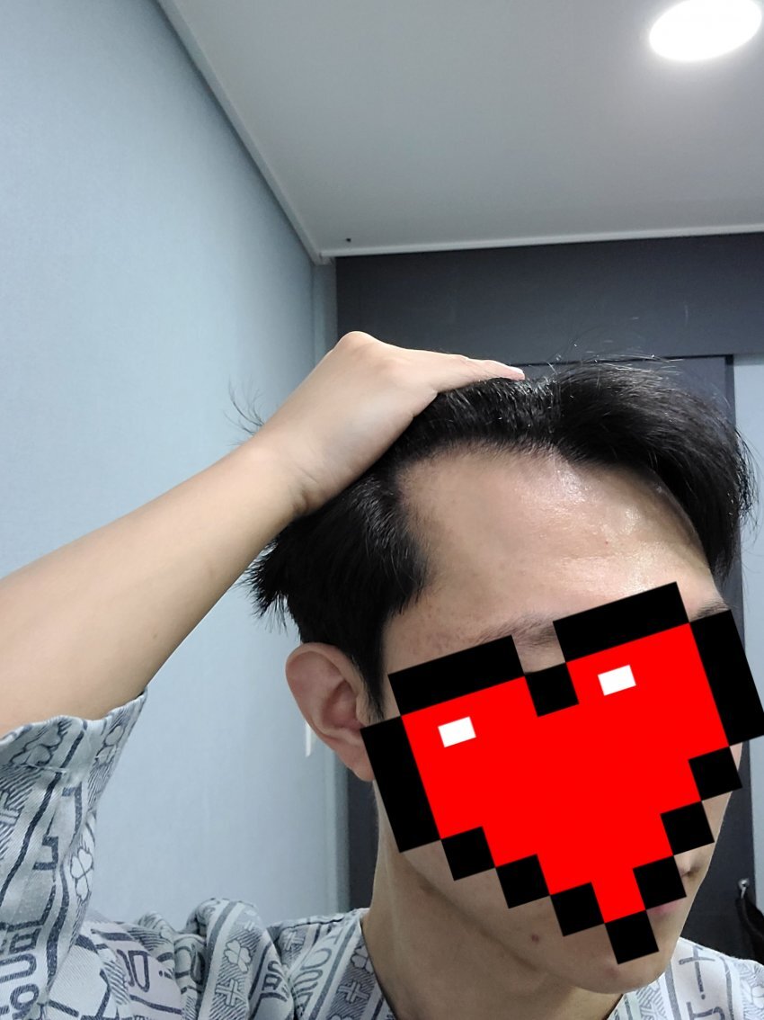 비절개모발이식후기