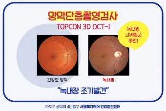 녹내장 진단 검사 비용 안압 검사주기 관리법_9