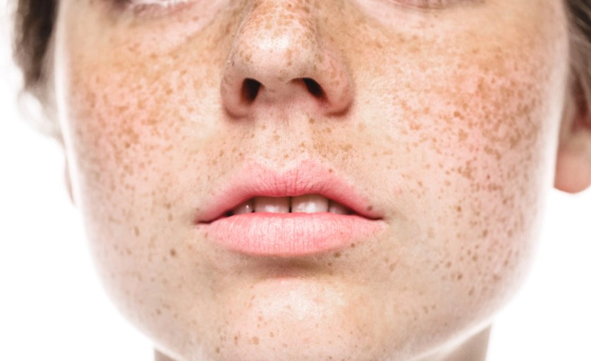 기미 없애는 방법