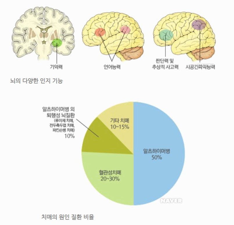 치매의 원인질환 이미지사진