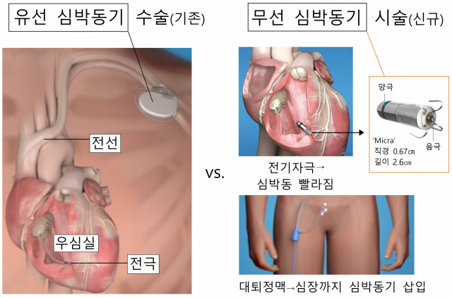 부정맥 시술
