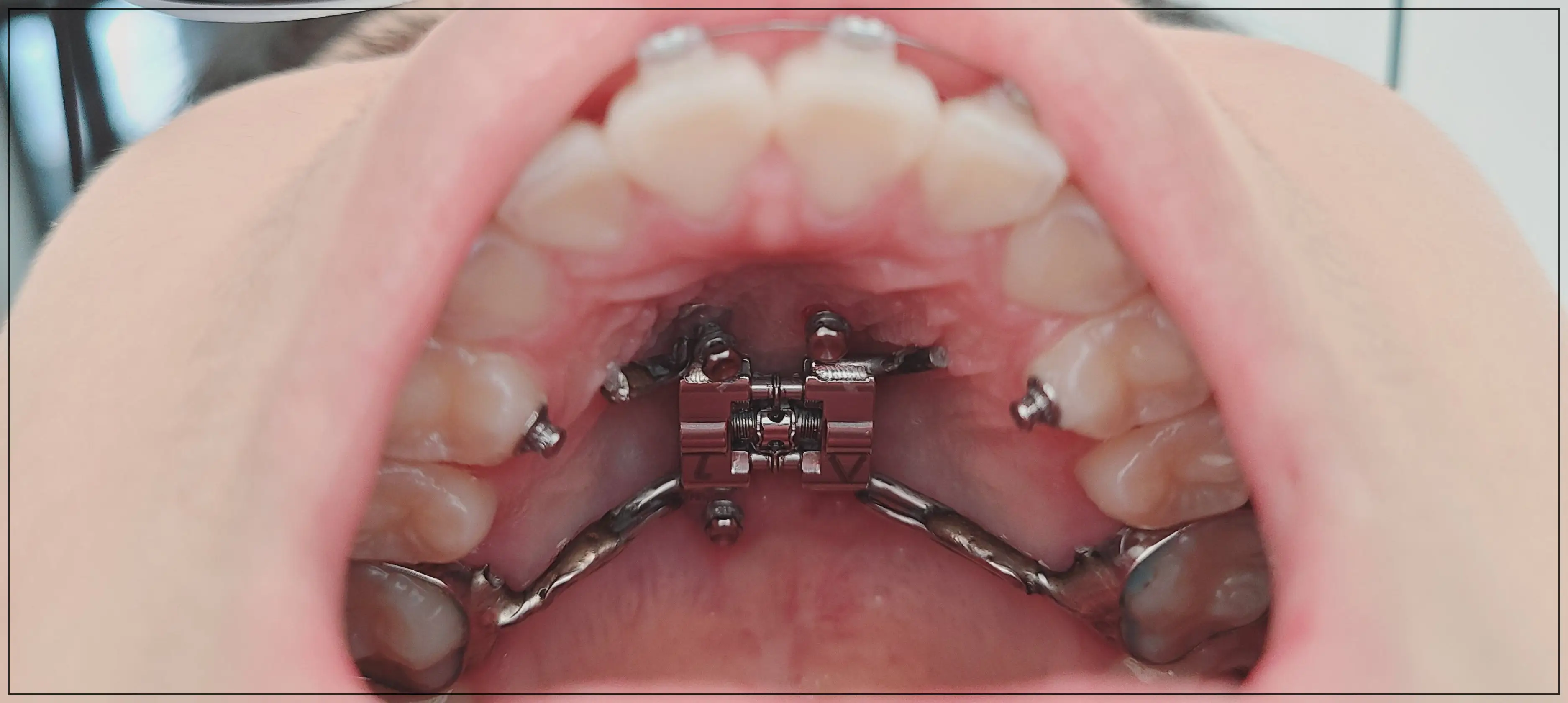 치아교정-입천장-나사
