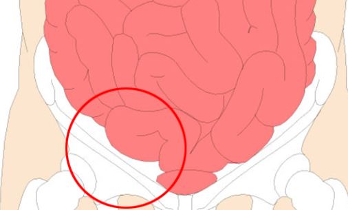 탈장 수술 비용 및 탈장 입원기간 총정리