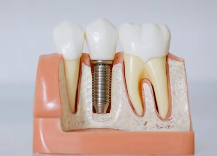 65세이상-임플란트-정부지원-받는방법