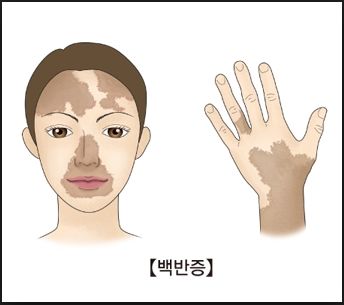 백반증 증상