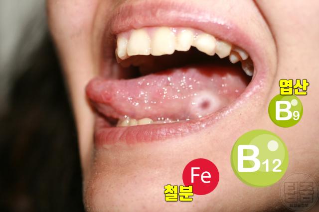 입 혀 염증 철분 엽산 비타민b12