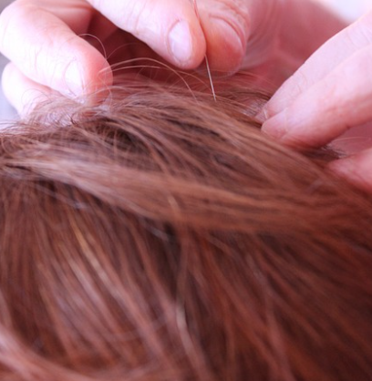 구안와사(안면마비)