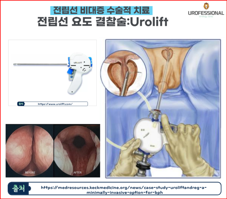 alt="전립선 결찰술 (Urolift)과정"