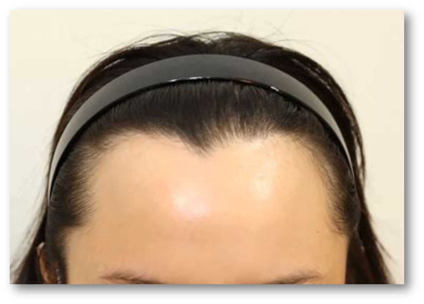 미녹시딜과 로게인폼3