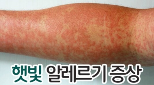 햇빛 알레르기 증상