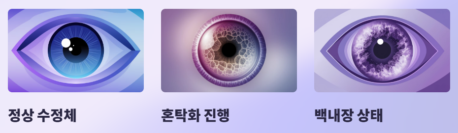 백내장 진행 현황