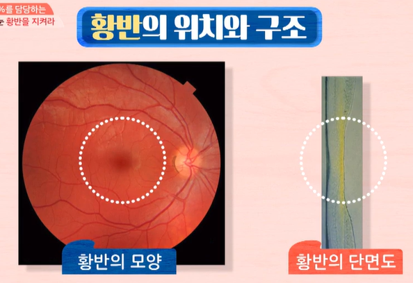 황반