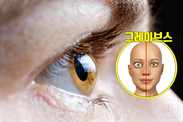 눈이 붓는 이유 눈 붓기가 안빠져요 눈붓기 원인 그레이브스병