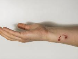 파상풍의 위험성