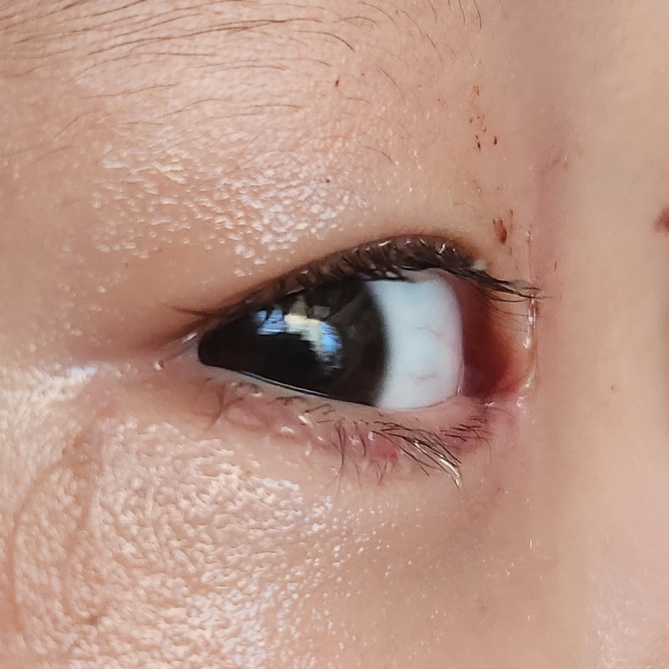 수술 2일 후 눈 옆모습