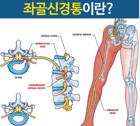 좌골신경통