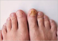 발톱무좀 이미지