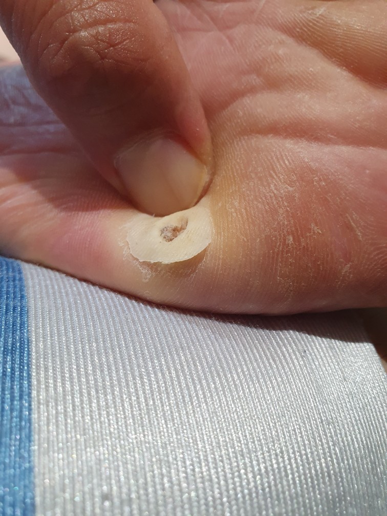 발바닥티눈사진