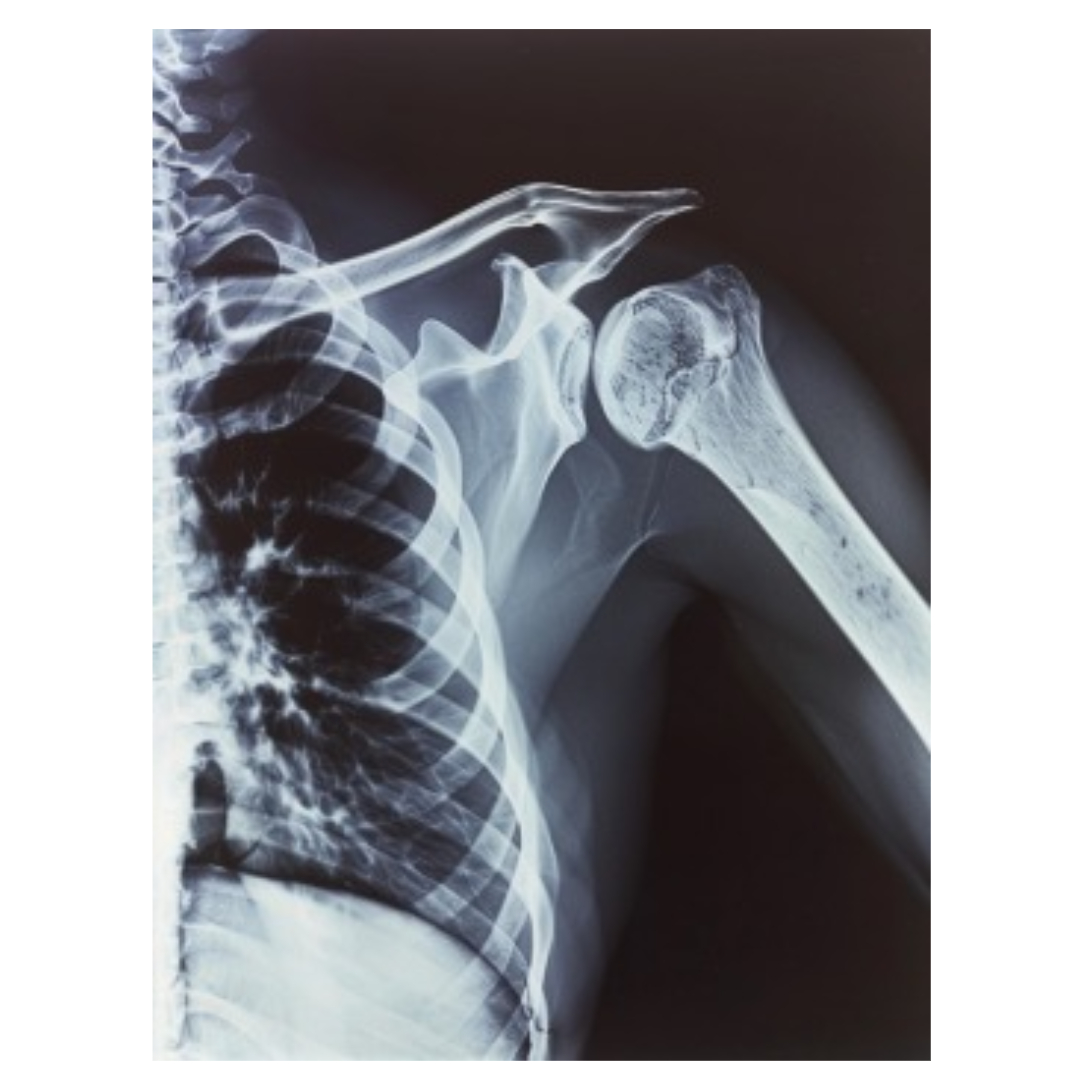 골다공증과 관련된 사진입니다.