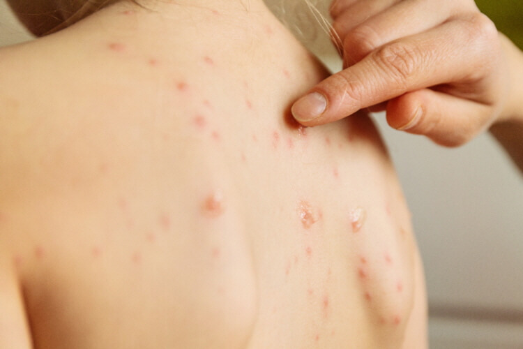 대상포진-썸네일