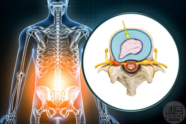 추간판탈출증 증상 디스크탈출증