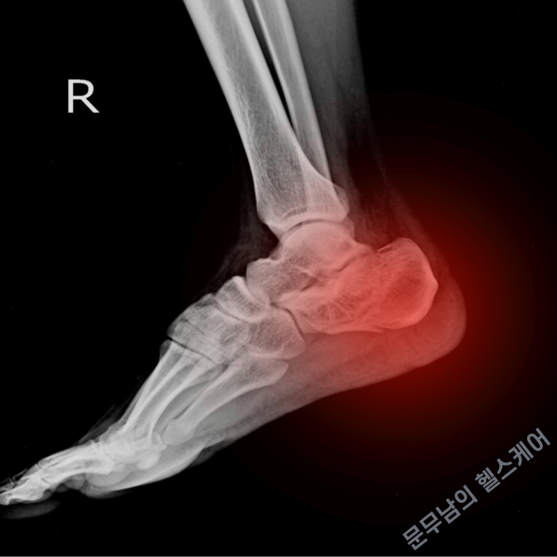 발뒤꿈치뼈 통증